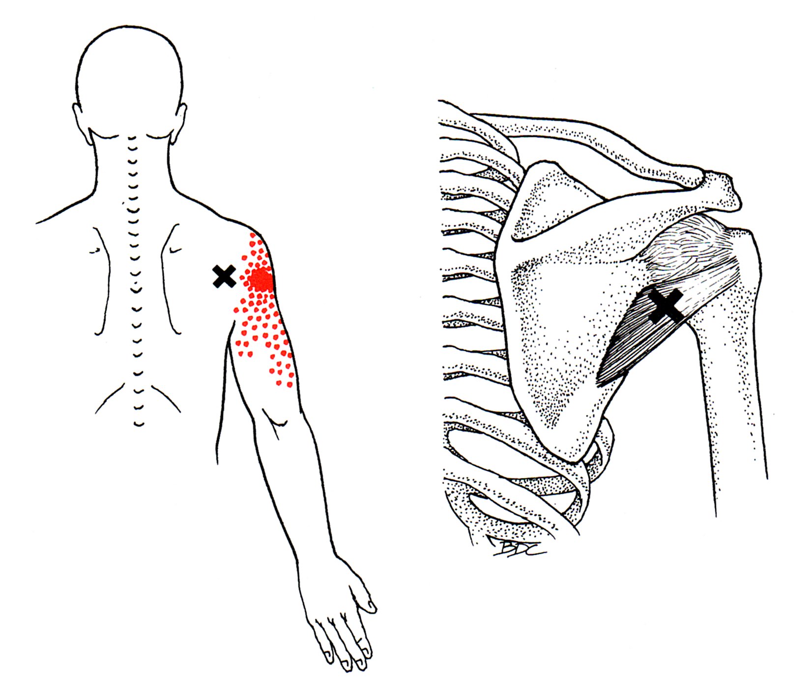 Sports Massage for Pain/Weakness When Lifting Your Arm EMotion